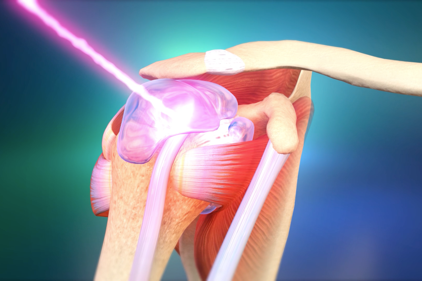 Video Poster - CureWave Lasers HILT Technology